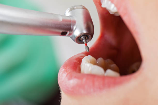 Best Emergency Root Canal Treatment in Land O Lakes, FL